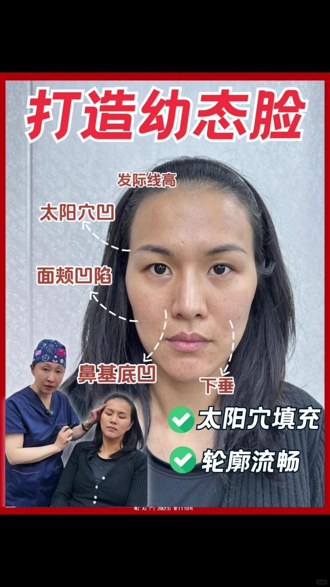 颧骨太宽怎么办有什么好办法吗