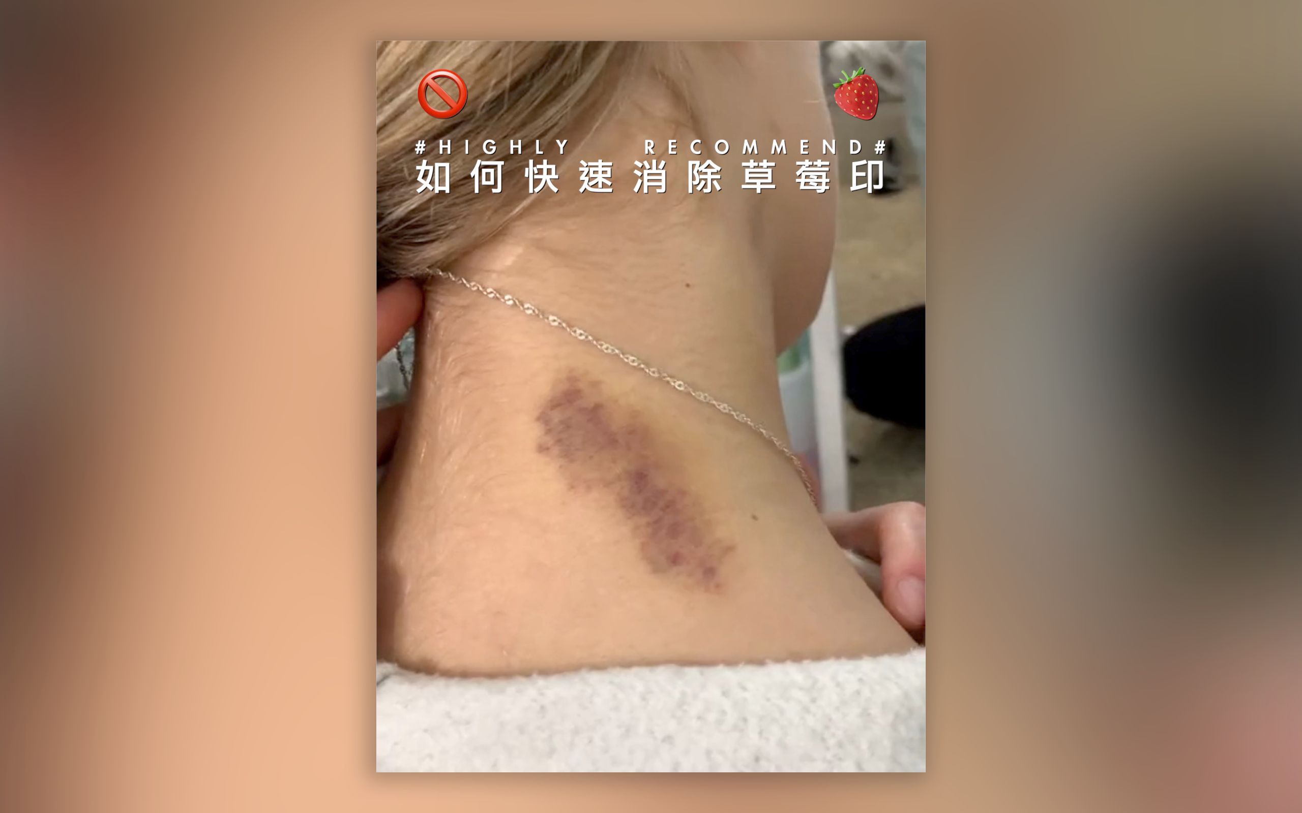 草莓印怎么消除