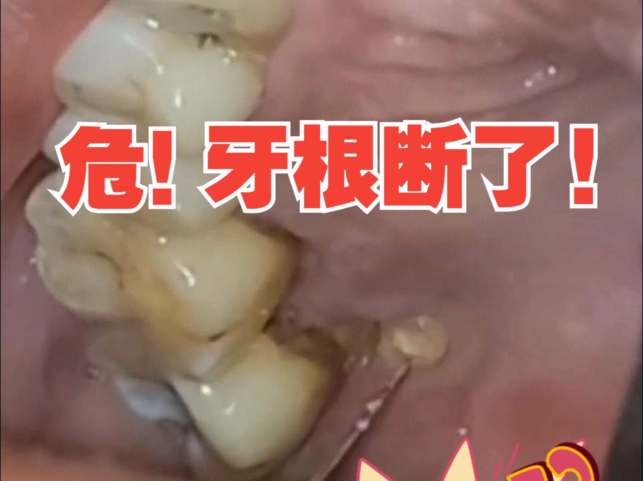 梦见下牙掉了一颗什么意思