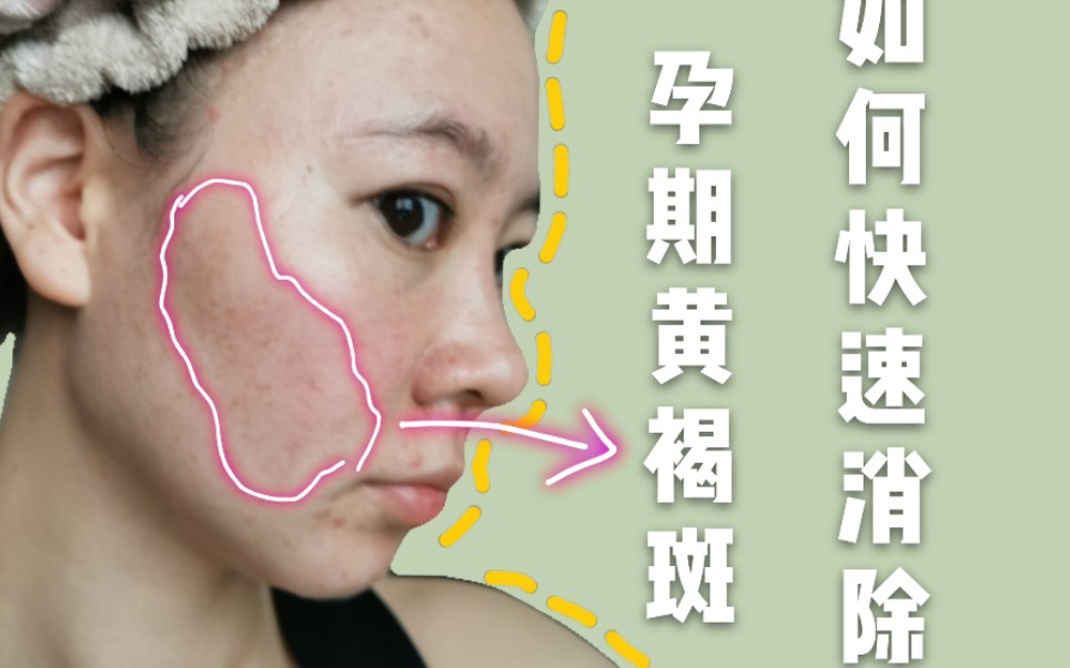 孕斑长什么样子